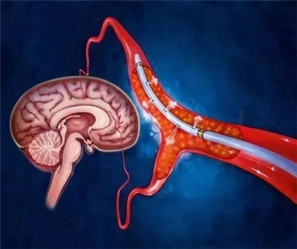 不想50岁被脑梗“缠身”，这4种食物再喜欢都别吃(1)